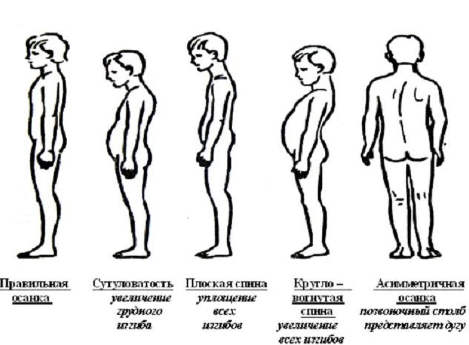 Виды осанки картинки